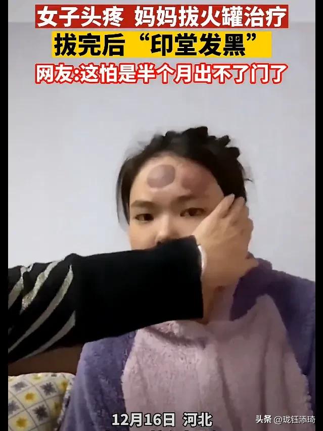 妈妈给闺女拔火罐疼哭了,女子头痛母亲额头拔火罐治疗