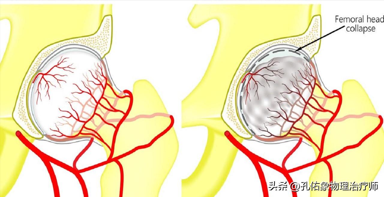 胯骨疼痛警惕四种病,身体有病是什么感觉