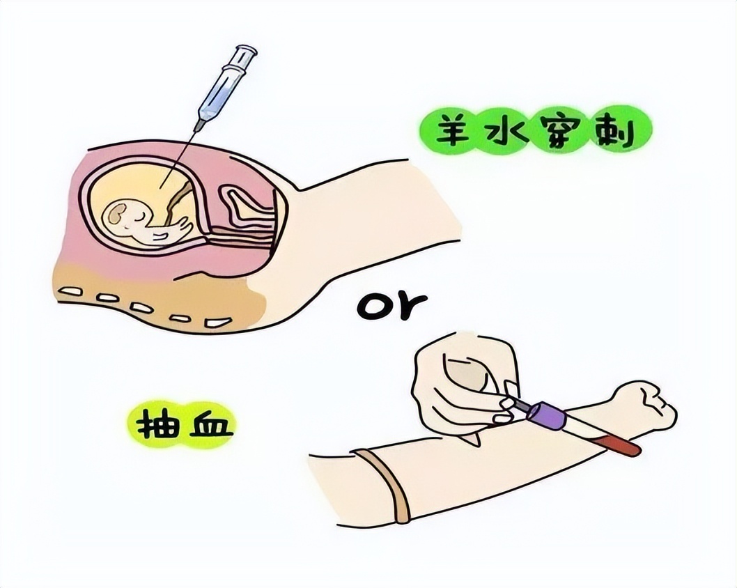 【六盘水市妇幼保健院健康科普】羊水穿刺小科普