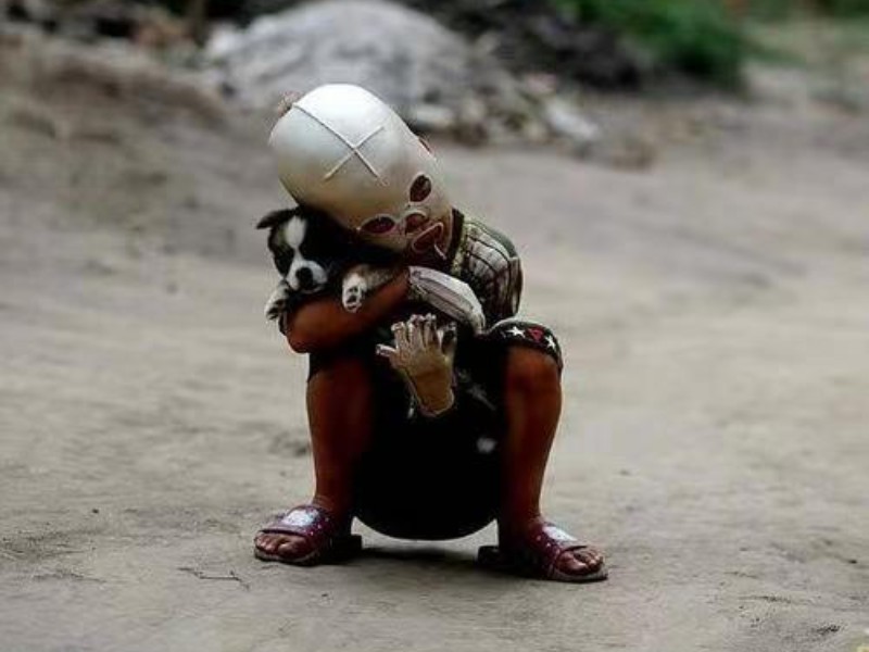 小孩被火烧伤戴面具,面具娃娃烧伤