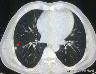 痰湿瘀阻结节用什么中成药调理,痰湿引起的结节中医怎么调理