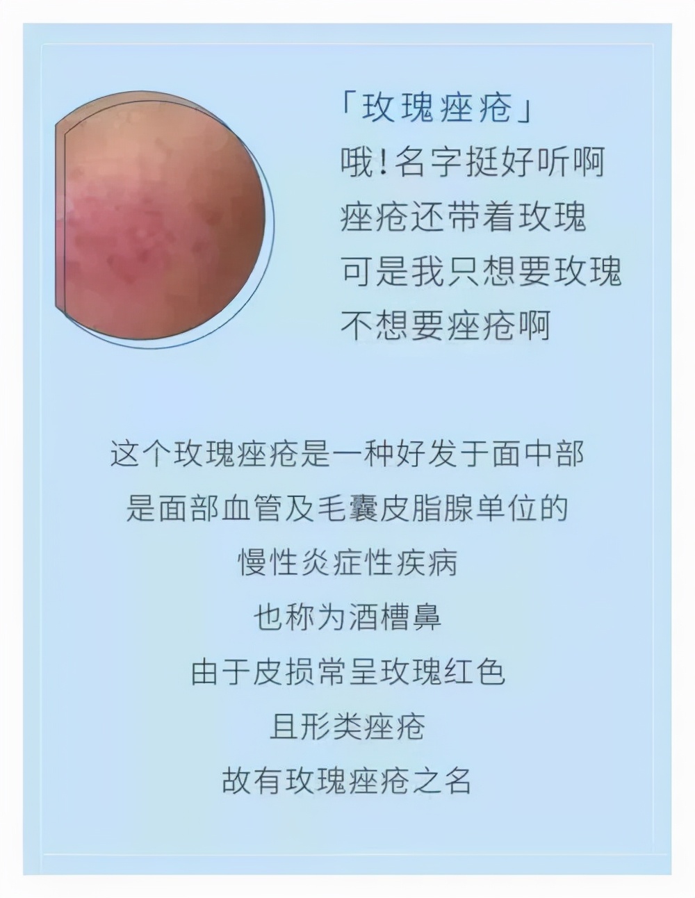 玫瑰*疮痤**的治疗