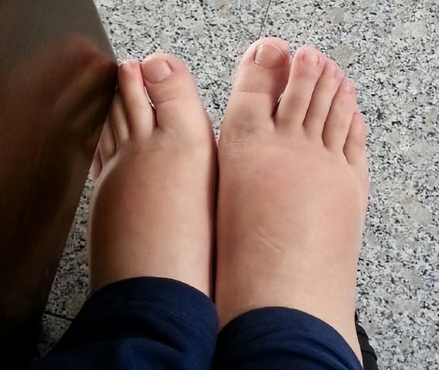 吃高嘌呤食物尿酸一般多久消失,哪些蔬菜嘌呤低尿酸高的人可以吃