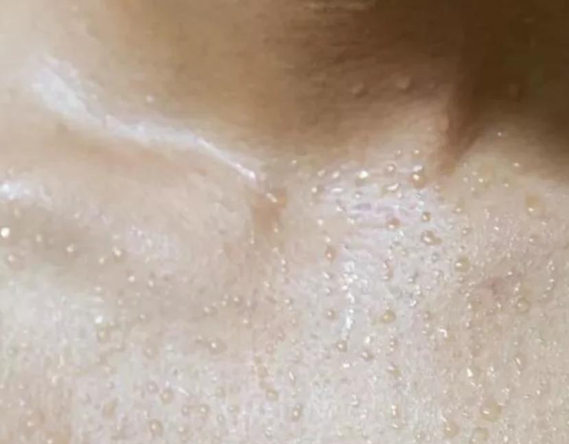 广汗法治疗银屑病效果怎么样,汗法治疗银屑病