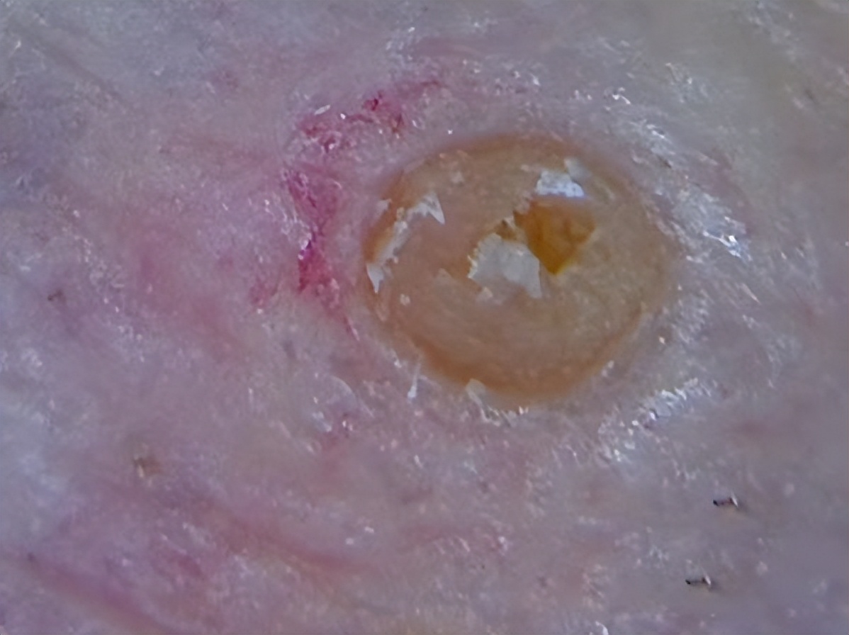 真黑头假黑头傻傻分不清楚，怎么去黑头？