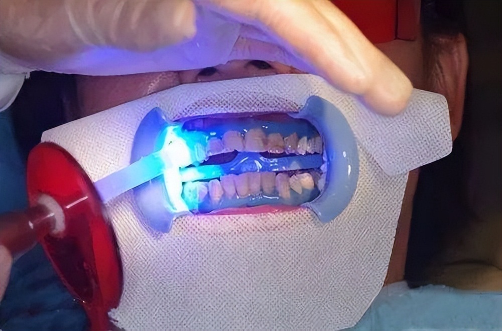 不用洗牙能把牙垢黄牙变白的方法,黑黄牙如何快速变白牙图片