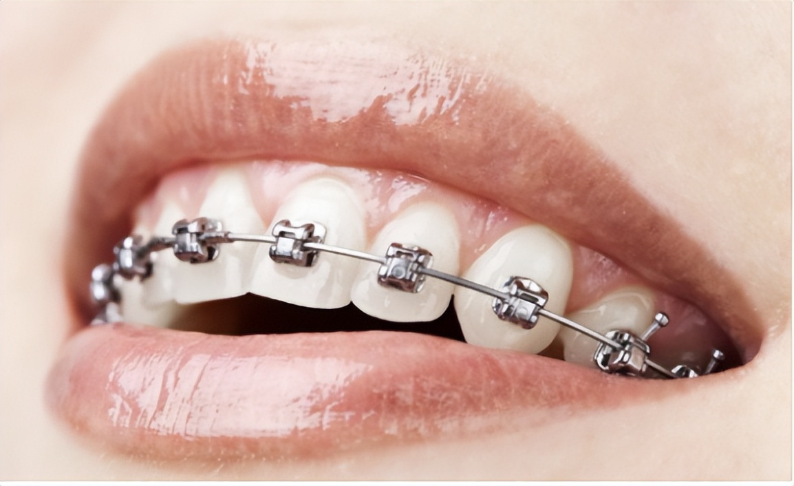 隐形牙套让一颗牙齿变高,隐形牙套让你在不知不觉中变美