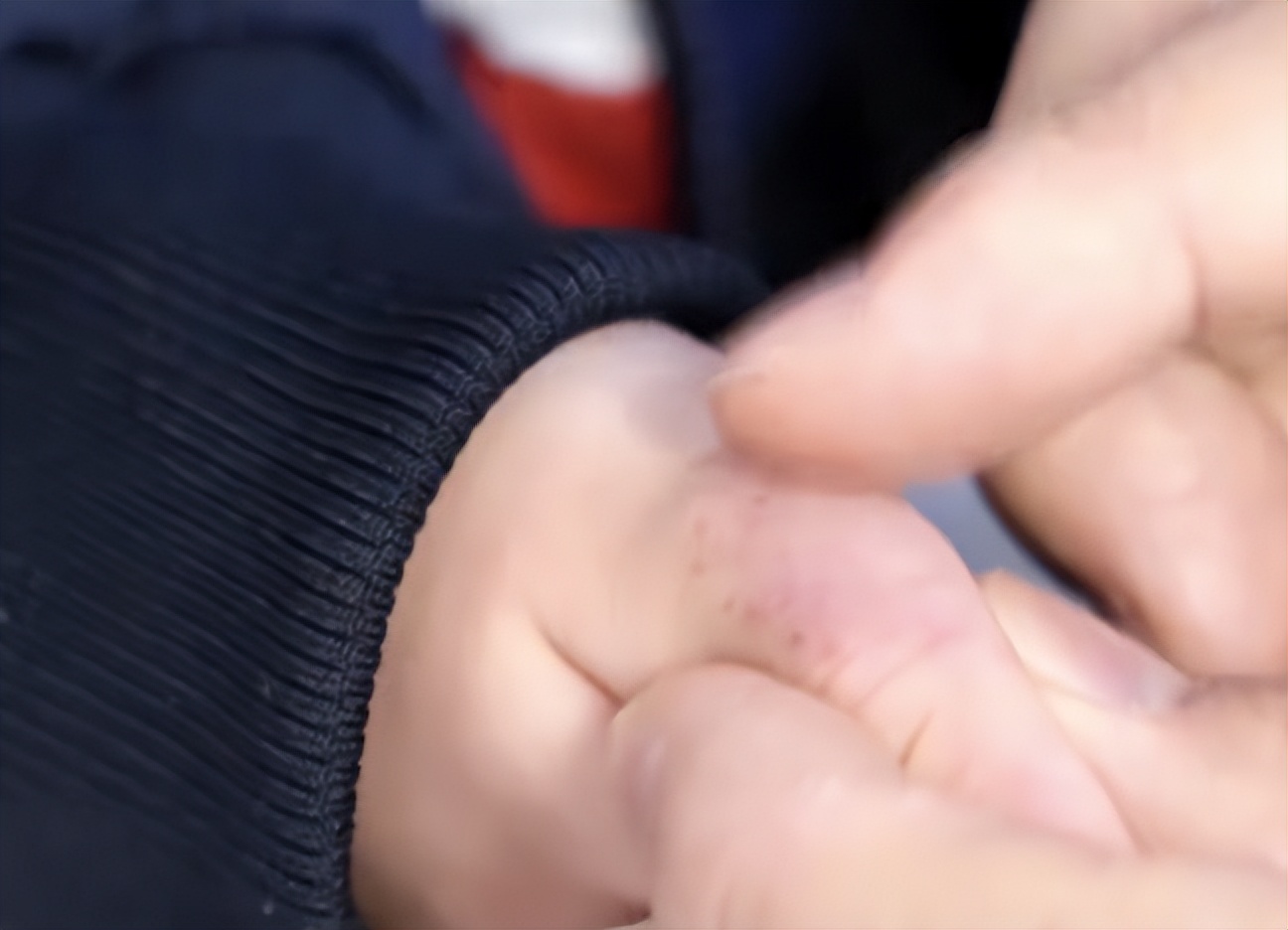 手上的血管畸形了是什么原因,手上血管畸形做硬化怎么操作