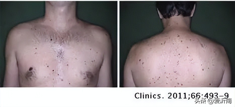 背上长了个肉痣是癌的象征吗,痣越多越容易得癌症