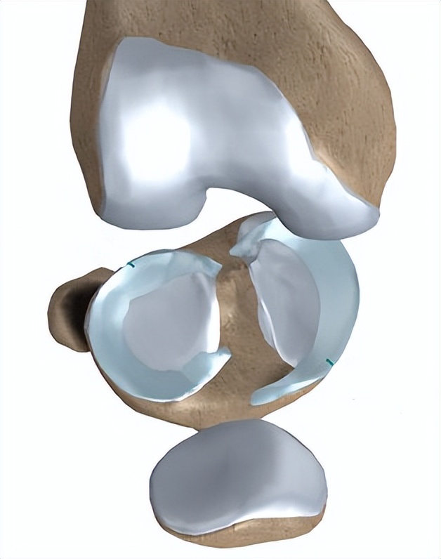 半月板撕裂三度自愈成功的案例,内侧半月板后角撕裂自愈要多久