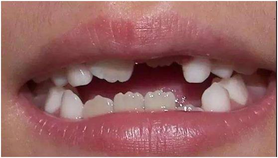 牙套崩瓷了属于保修范围吗,牙套矫正失败怎么办如何索赔