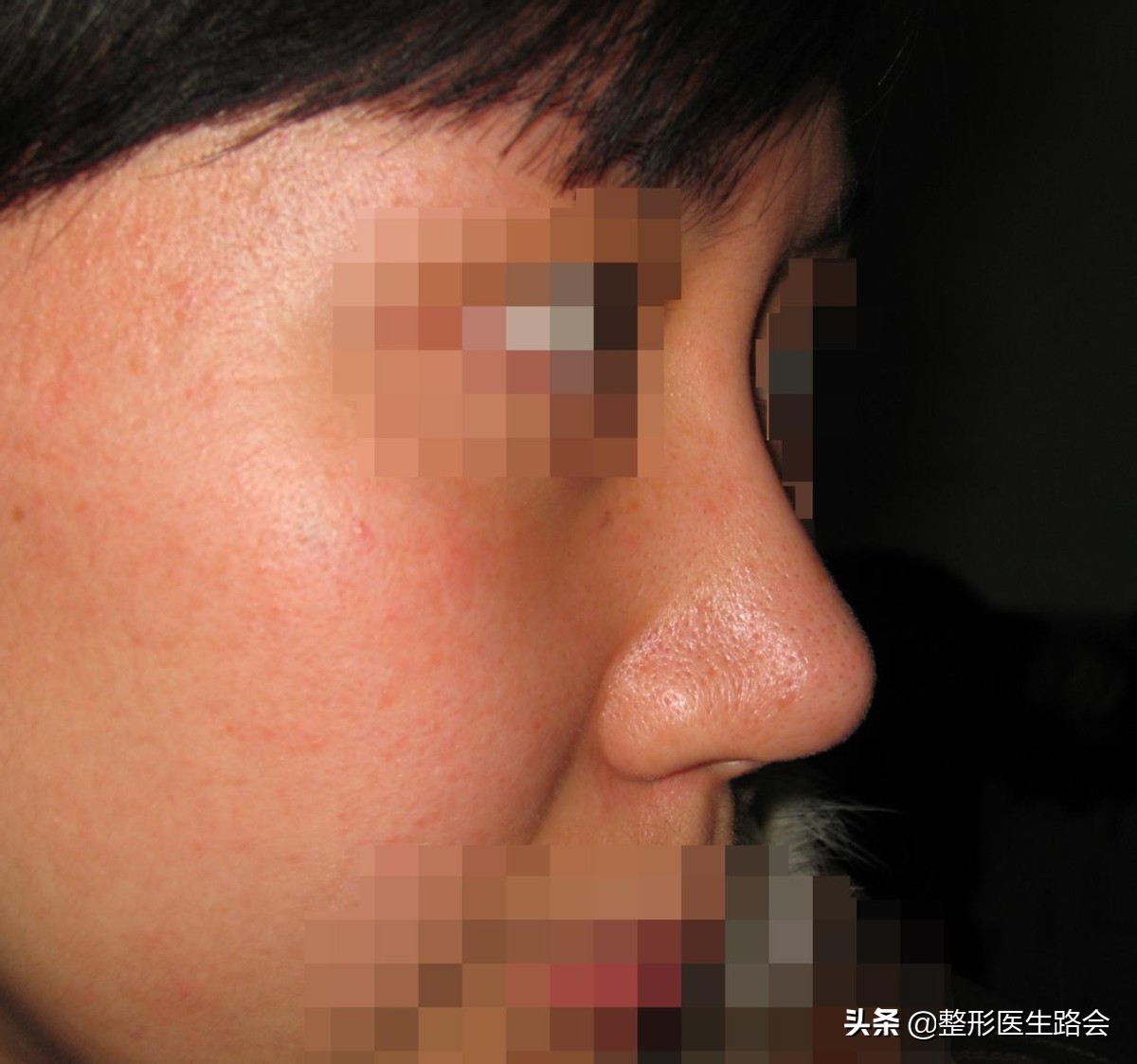 硅胶隆鼻5年歪了怎么修复,隆鼻10天歪了可以矫正吗