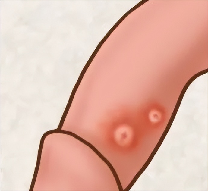 裤子都脱了，你就给我看性病？这6种疾病可要分清