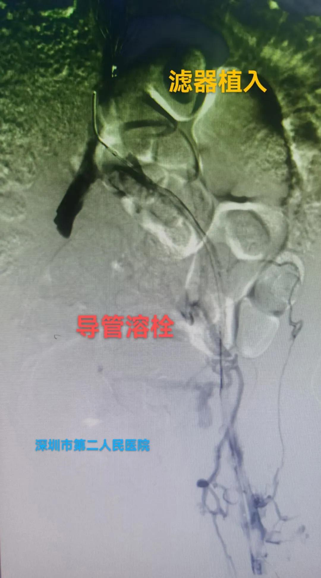 一到下午就腿肿什么原因怎么治疗,腿肿是什么病的前兆怎么治疗
