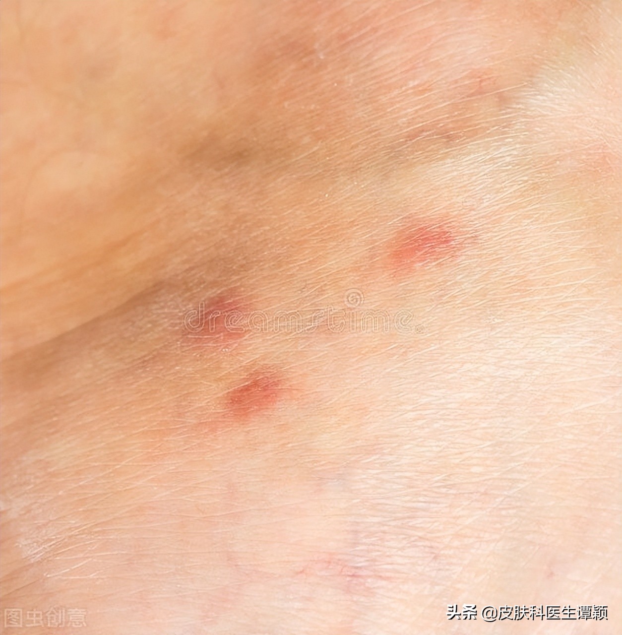 丘疹性荨麻疹皮炎有哪些忌口,丘疹性荨麻疹止痒小妙招是什么