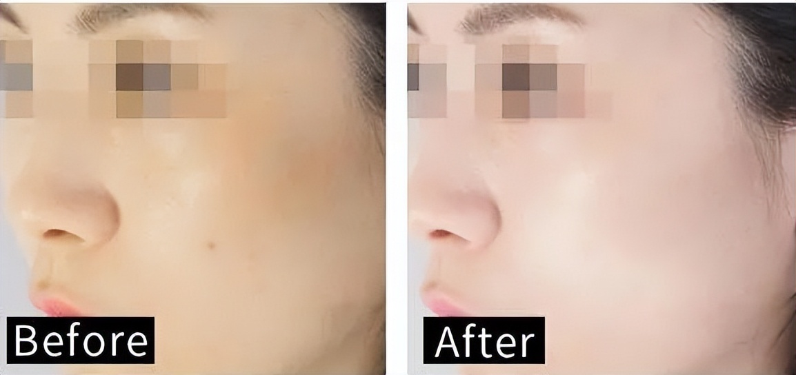 花漾缘面膜,花漾缘祛痘清洁面膜