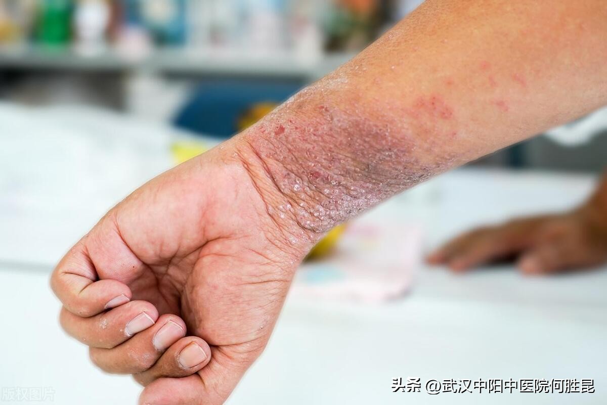 腿上腰上后背有硬疙瘩,胳膊腿痒越挠越痒局部肿块