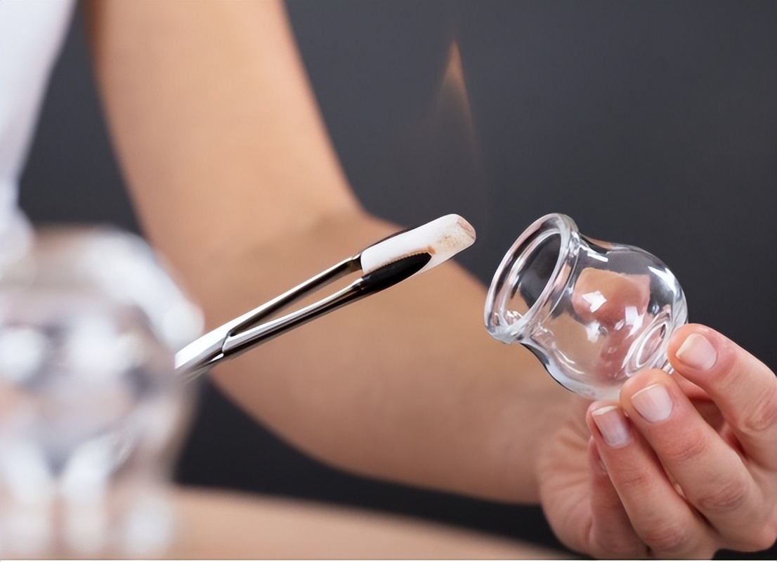 拔火罐吸出来的淤血，是体内的毒素？告诉你真相，看完涨知识