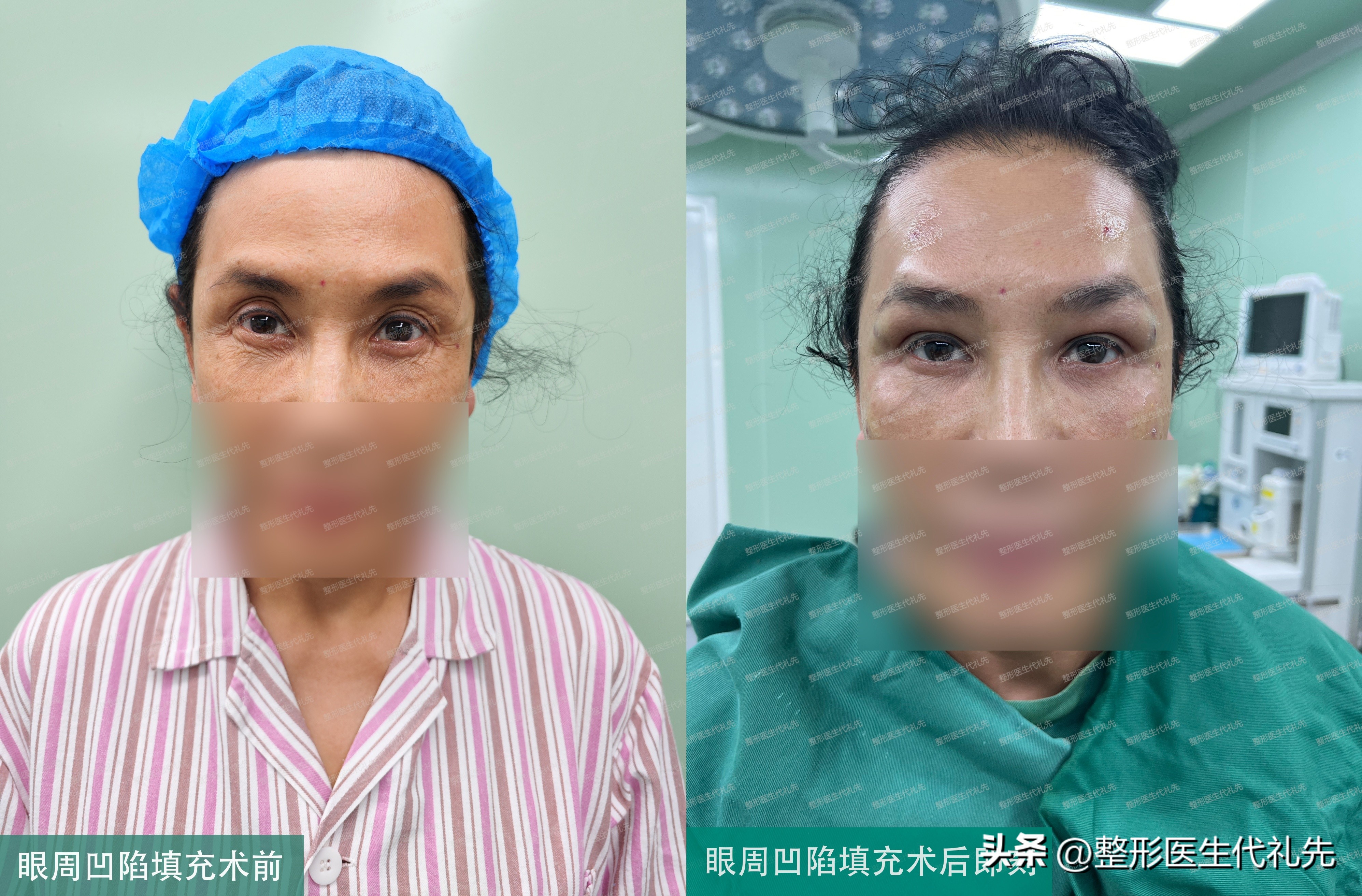 眼窝凹陷填充手术后注意事项,眼窝凹陷填充术后遗症