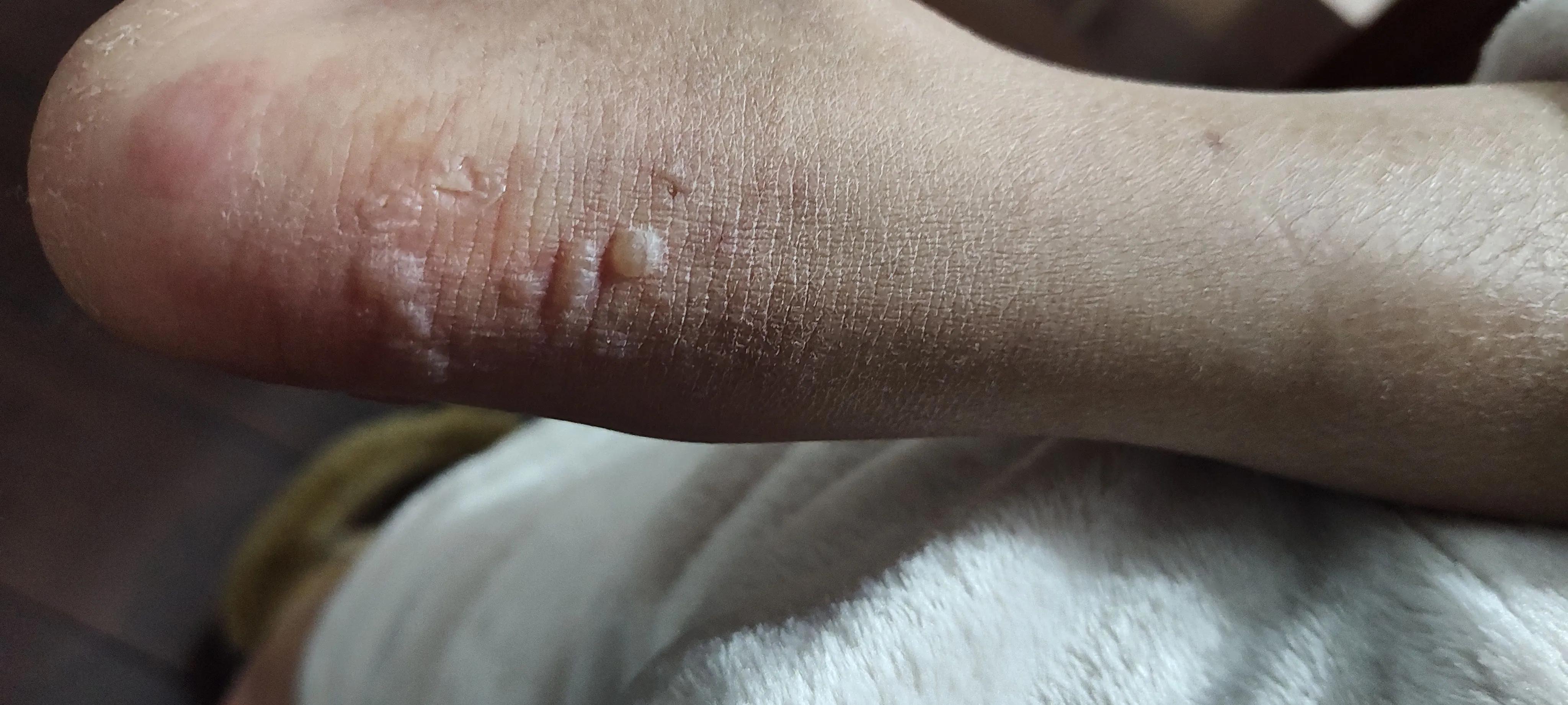 脚后跟红肿起硬皮怎么办,脚后跟红肿怎么处理