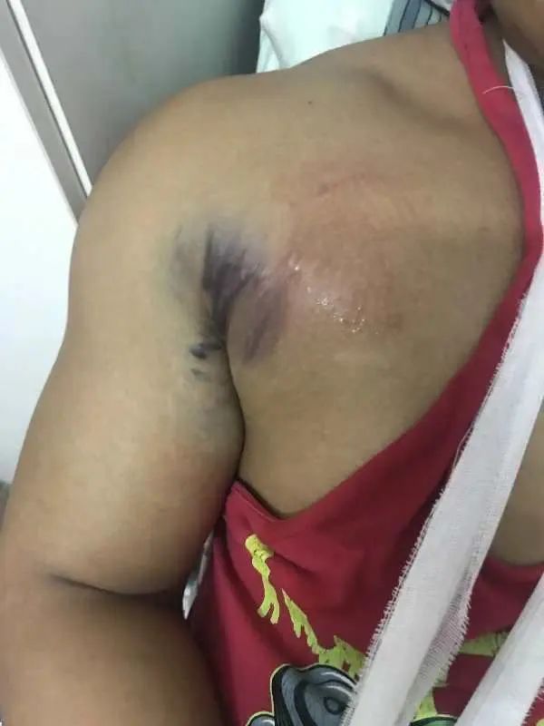 卧推200kg被砸,小伙卧推失误被锁喉过程揪心