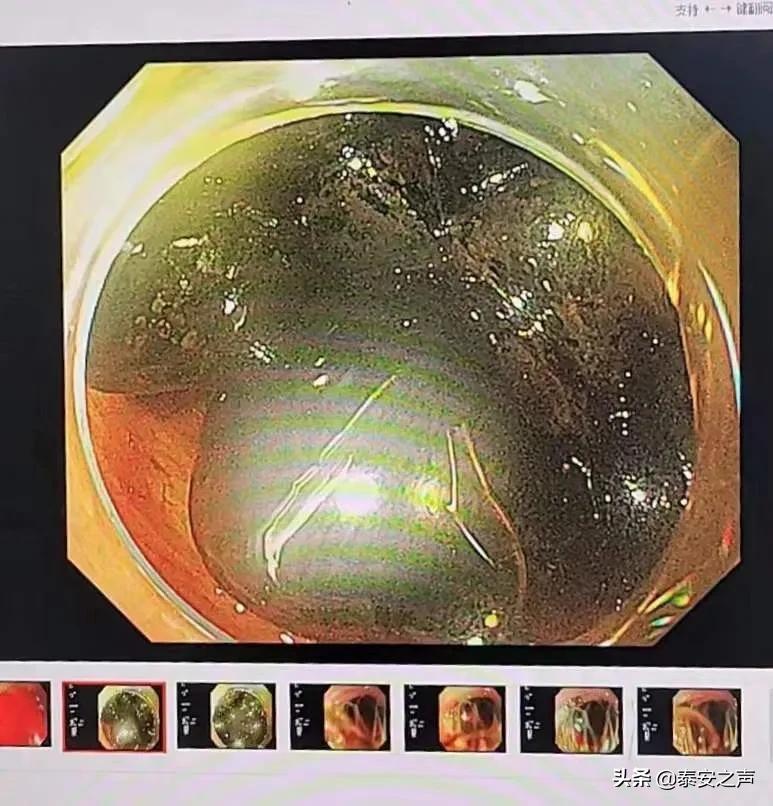 惊了！保胆取石取出164枚结石！这个团队是怎么做到的