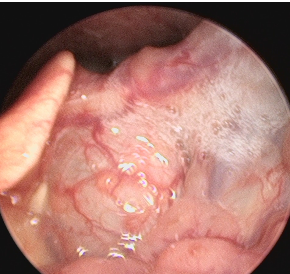 颈部有肿块不痛不痒严重吗,颈部肿物恶性的可能大吗