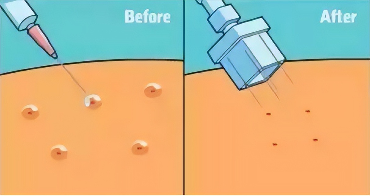 水光针多久可以护肤,水光针多长时间能护肤