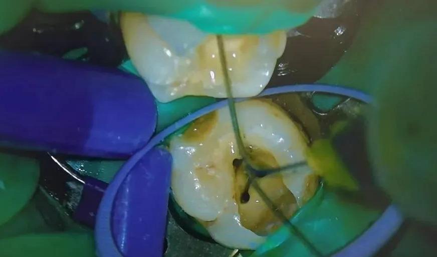 烂牙发黑根管治疗全过程,让牙齿重生的妙方