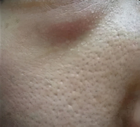 改善毛孔松弛粗大偏方,毛孔变粗大的解决方法