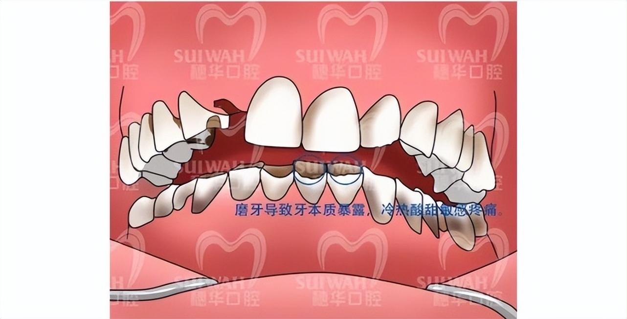 睡着磨牙齿是什么原因怎么治疗,磨牙牙齿变黑是怎么回事