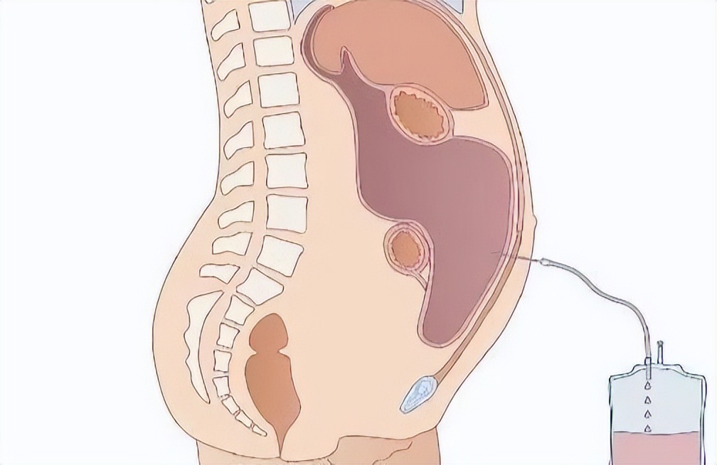 肝硬化病人水肿怎么回事,杨医生讲早期肝硬化的症状