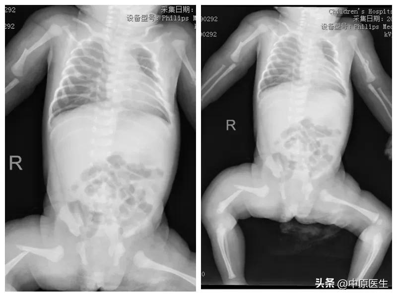 刚出生小婴儿头颅骨折如何发现,刚出生宝宝骨折大夫有责任吗