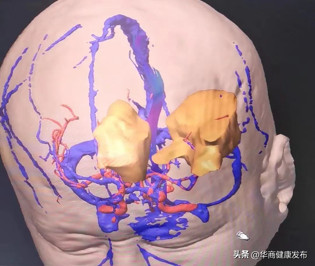 西北首台术中核磁共振登场！术中“核*器武**”精准制导切除多部位颅内肿瘤