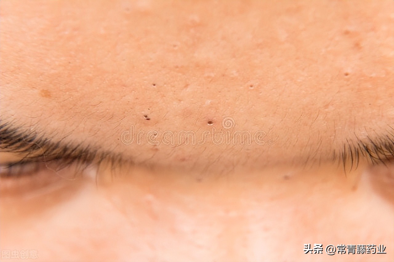 皮肤科医生教你两个月去掉黑头,如何去除黑头医生建议