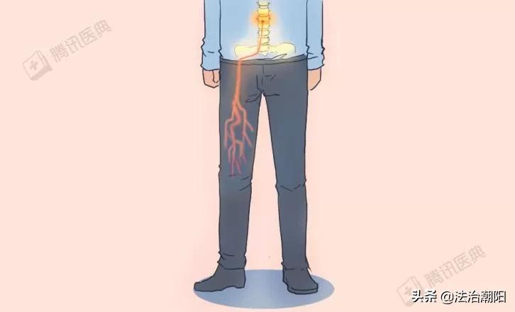 睡硬板床不能治腰椎间盘突出！3个小误会一次说清