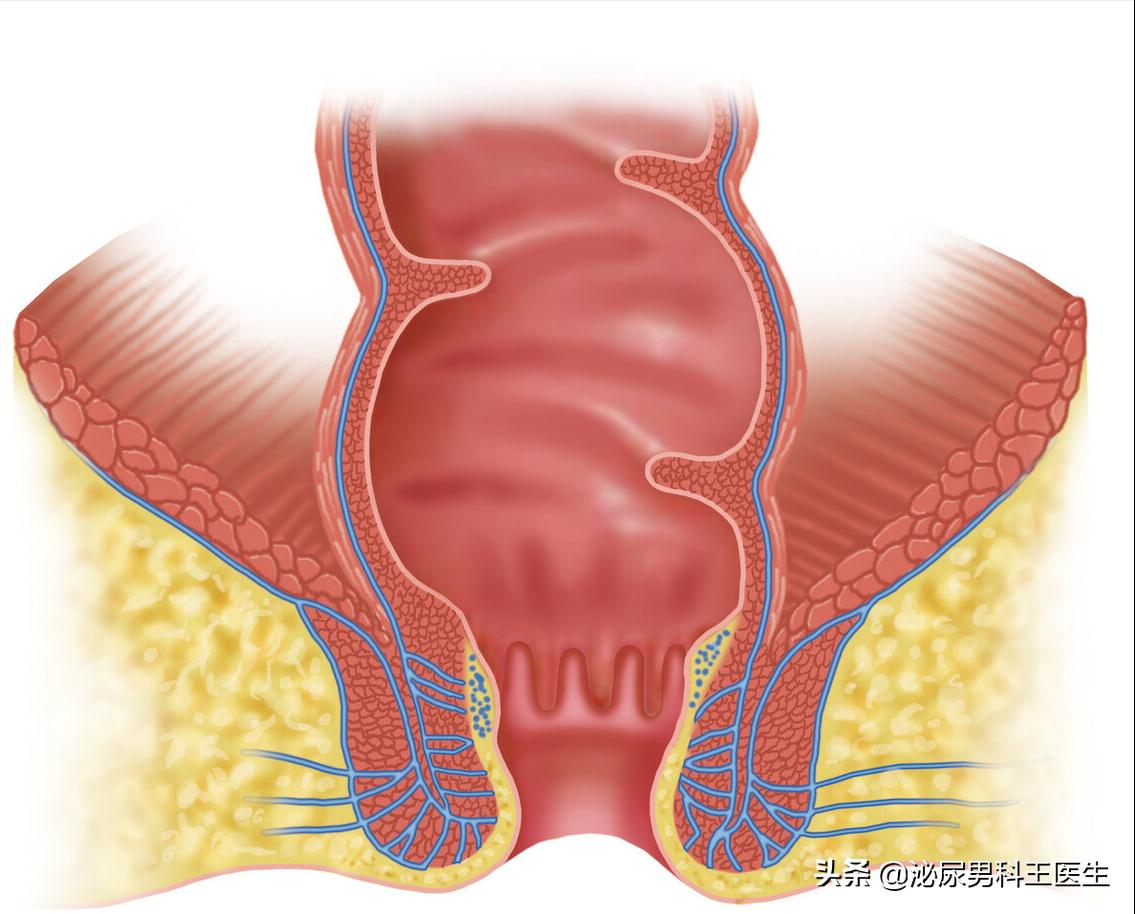 肛瘘不想做手术怎么保守治疗,为什么肛瘘手术后才是痛苦的开始