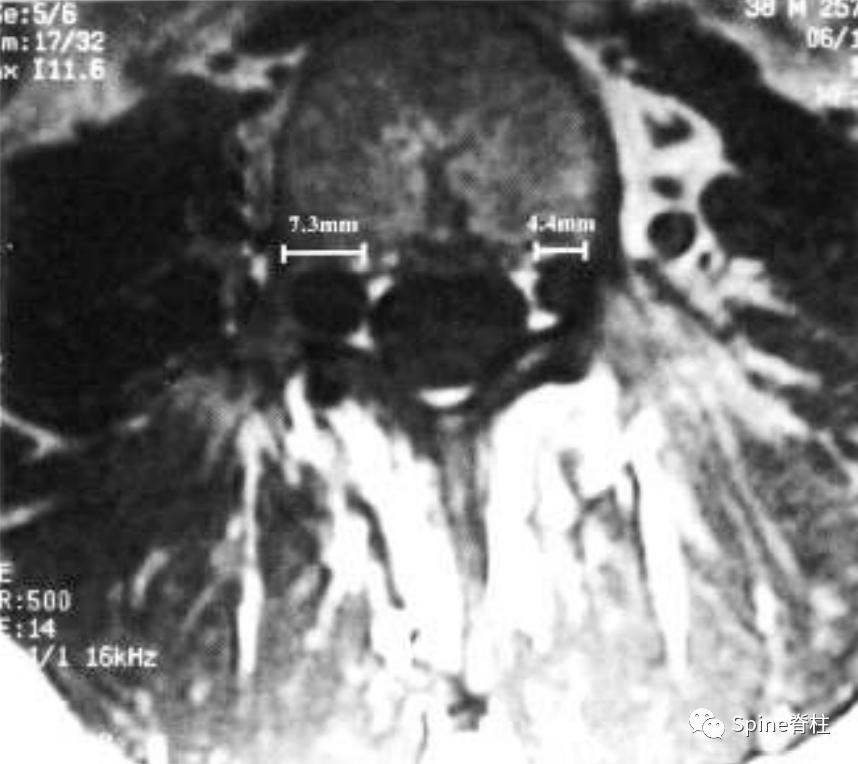 硬膜囊扩张是什么意思,硬膜囊扩张压迫神经