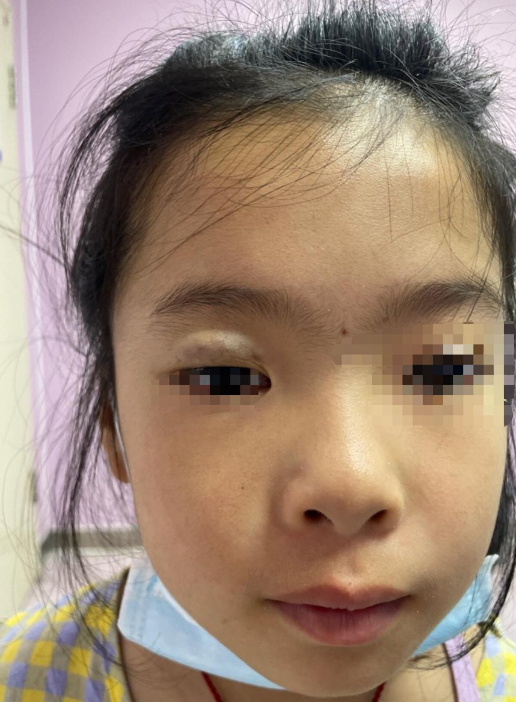 成人先天性眼睛长了血管瘤怎么办,新生儿血管瘤和先天性血管瘤