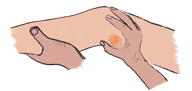 髌骨脱位用膝盖固定支架,髌骨脱位的原因