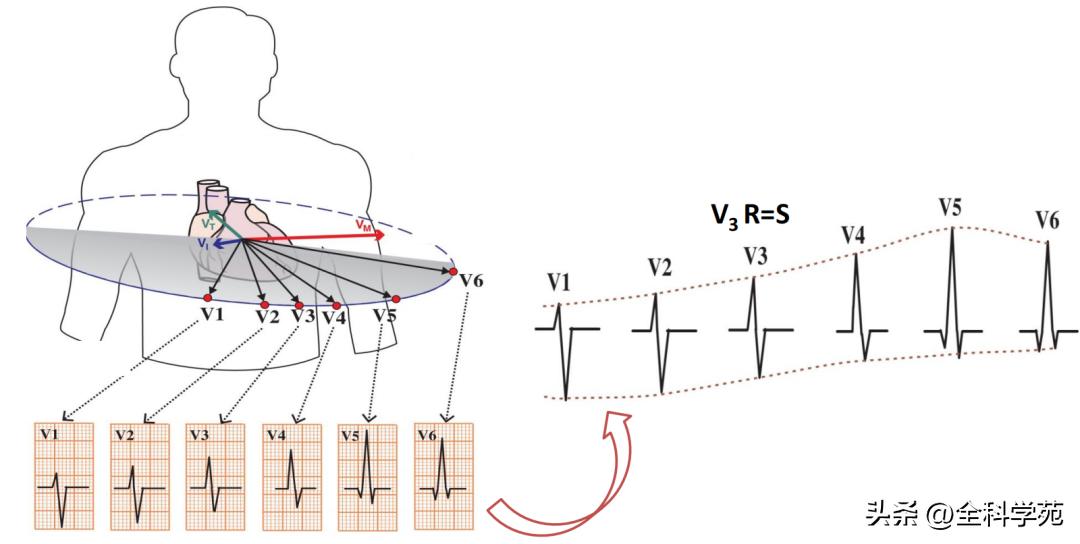 心电图笔记26：QRS波振幅变高，需要想到哪些