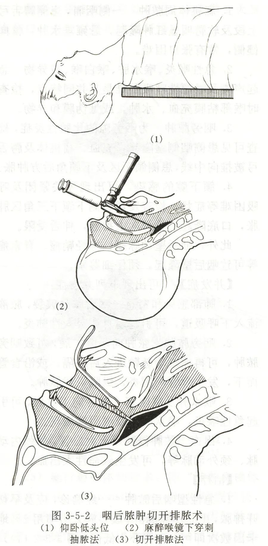 咽喉脓肿临床表现,咽旁脓肿临床表现与治疗