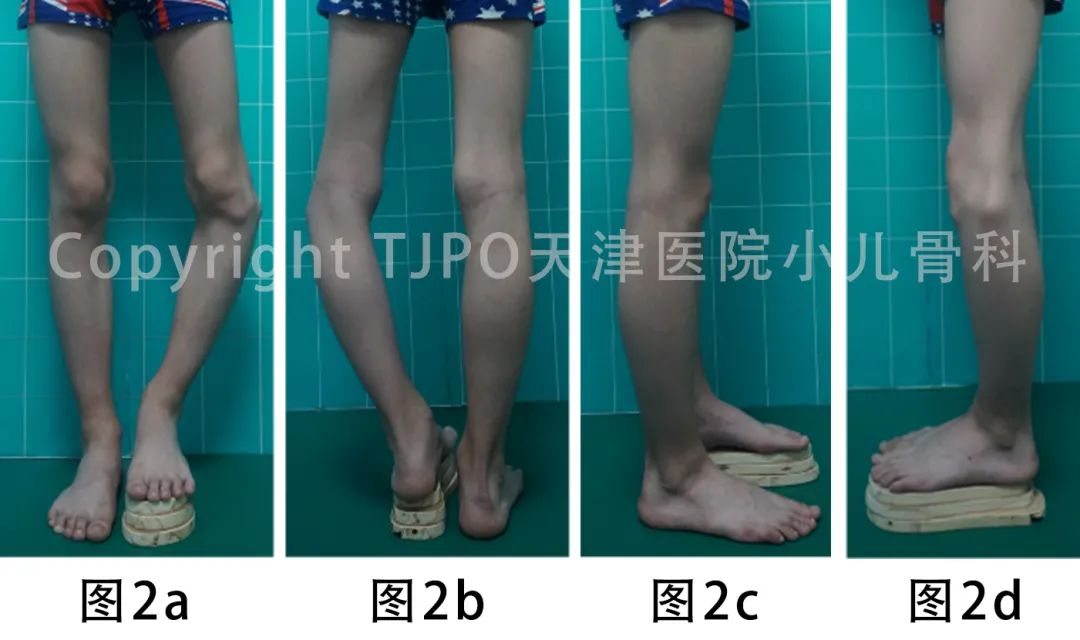 病例分享｜泰勒外固定支架逐渐矫正胫骨近端内翻伴短缩畸形