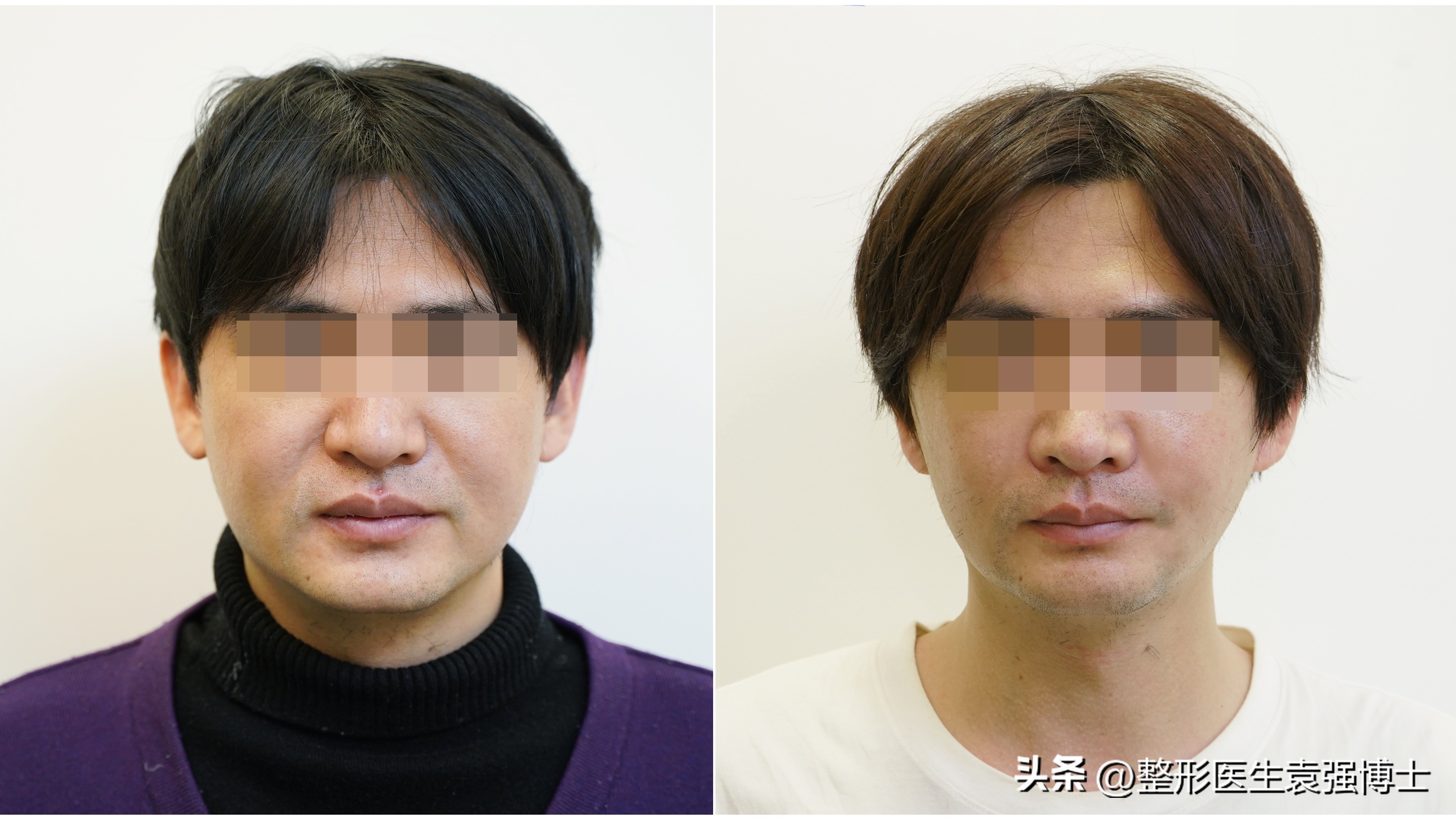 拉皮手术前后的感受,拉皮手术全面解答