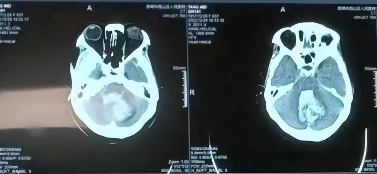 送医时间决定治疗效果！六旬老人突发脑出血送医及时恢复良好