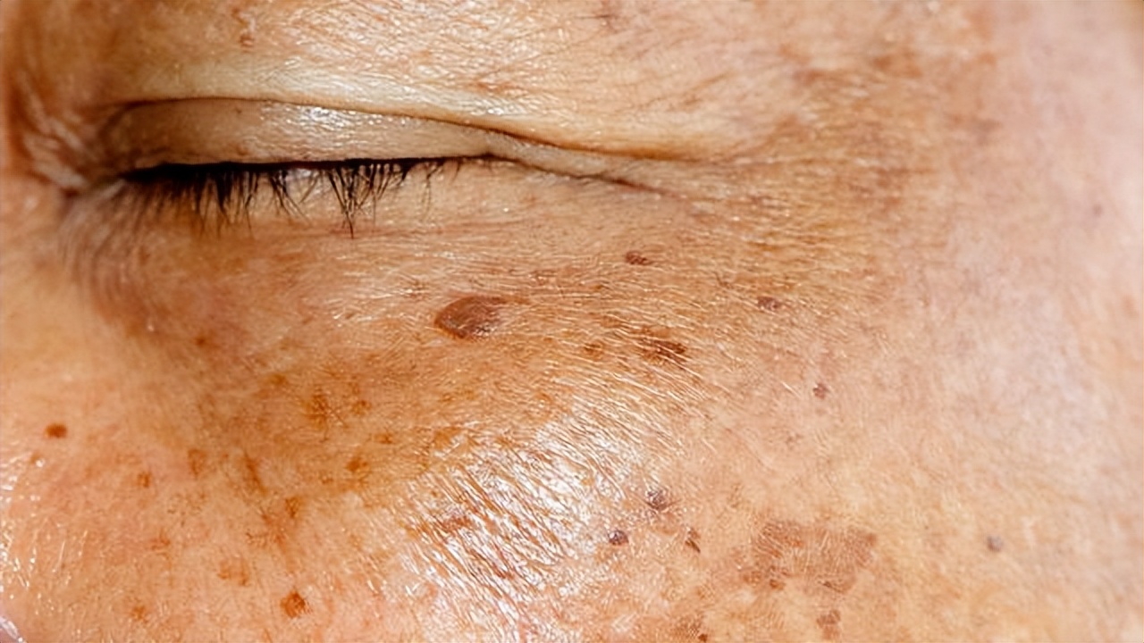 祛老年斑涂抹什么药膏有效,快速消除老年斑的小妙招红霉素