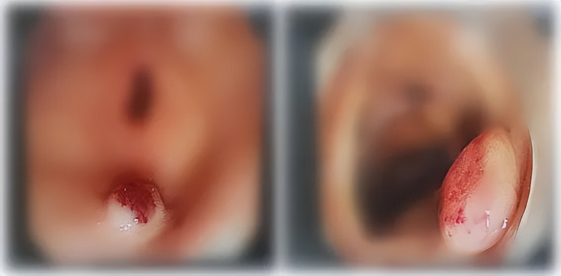 婴儿草莓状血管瘤怎么治疗 (宝宝贫血鲜红斑痣颜色)