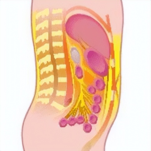 治疗腹膜癌的靶向药有哪些,腹膜癌特效药