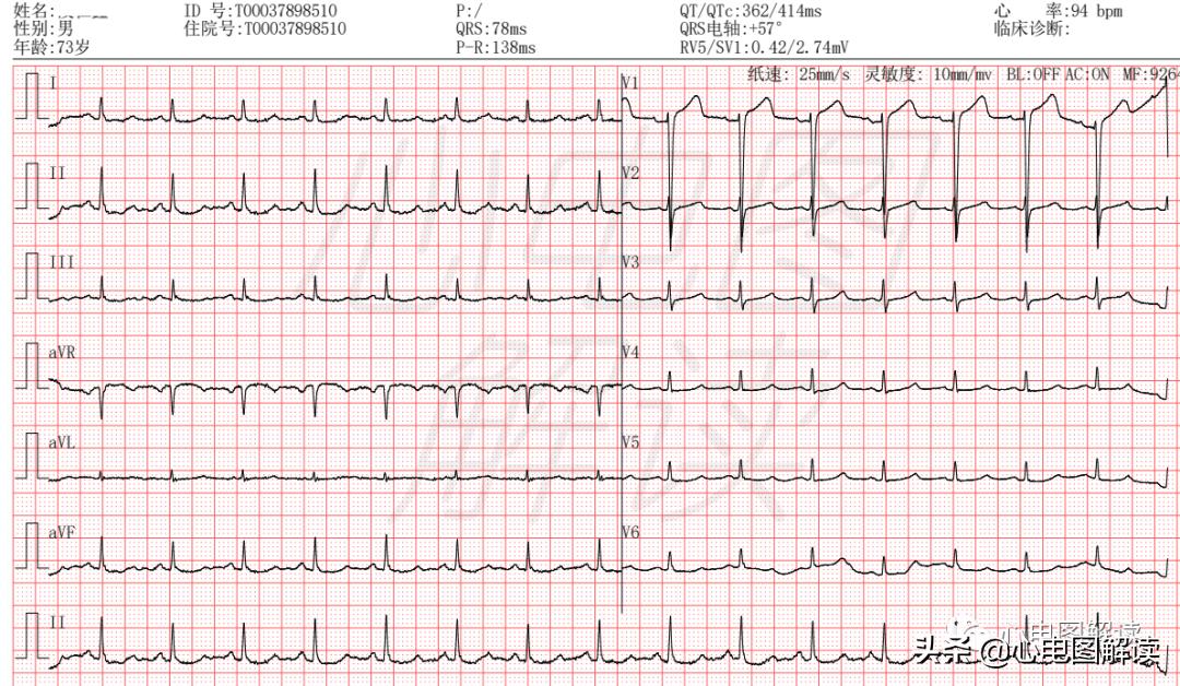 胸导联低电压危害,胸导联低电压临床意义