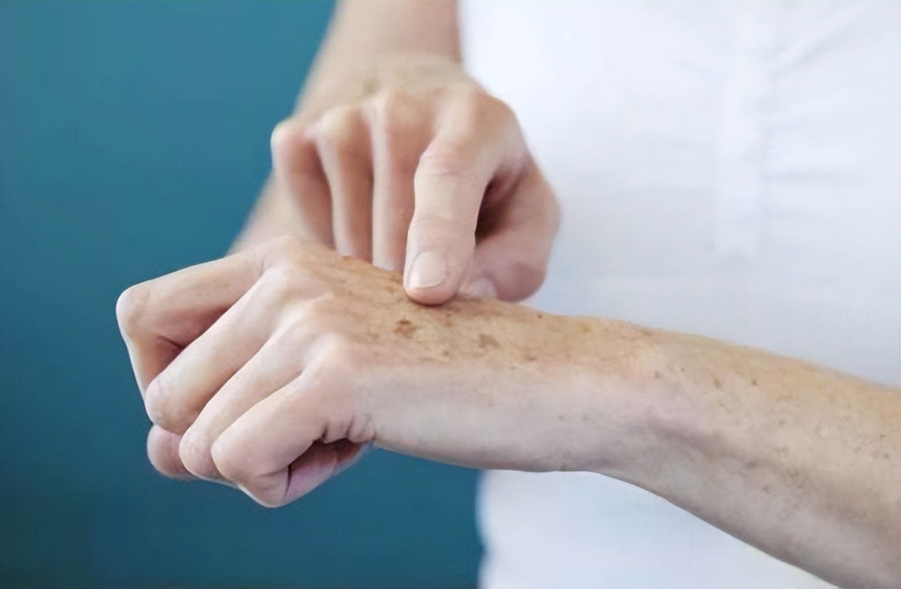 人长老年斑是什么原因,快速消除老年斑的小妙招红霉素